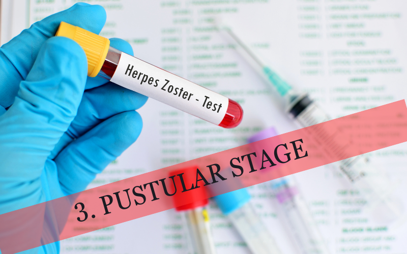 Pustular Stage The Turning Point in the Battle