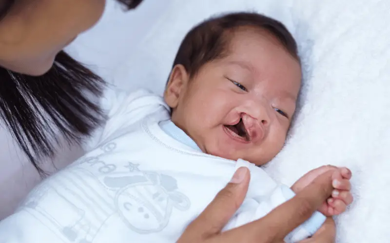 5 Leading Causes of Cleft Lip Delving into the Underlying Factors