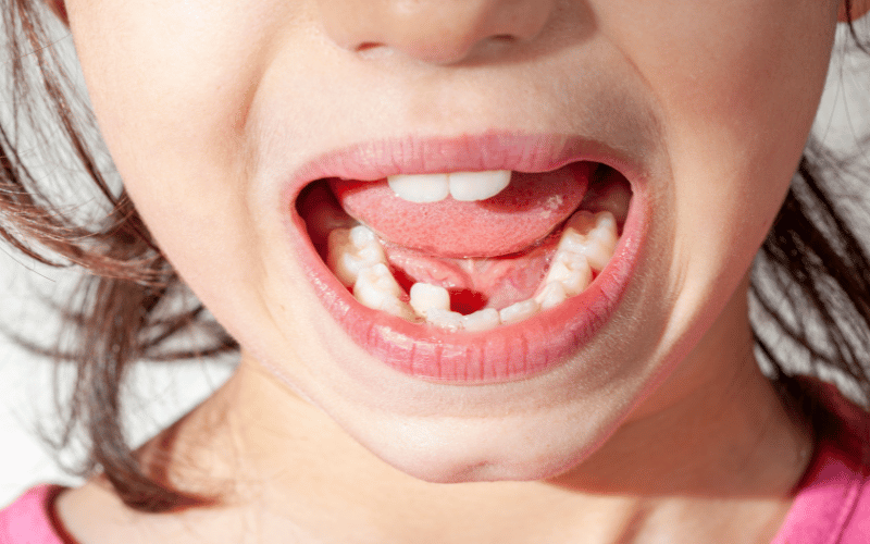 Misaligned Teeth The Dental Tell-Tale