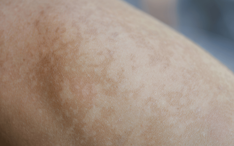 Skin Pigmentation Whipple Disease's Unpredictable Canvas