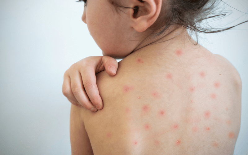 The Chickenpox Connection A Childhood Illness Returns