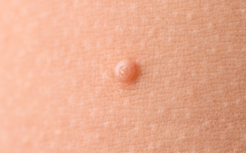 Umbilicated Center Molluscum Contagiosum’s Unique Impression