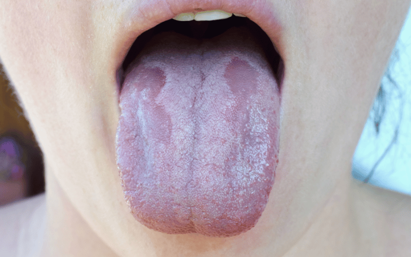 Co-existence with Oral Thrush Leukoplakia's Paradoxical Twin