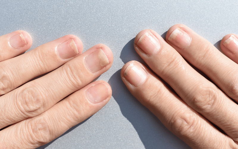 Nail Anomalies Pemphigus's Fingerprint on the Tips