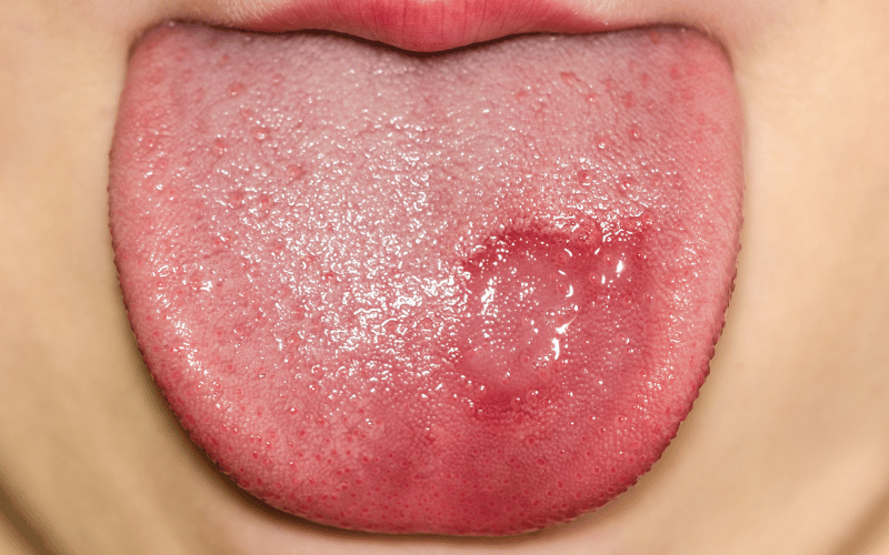 Association with Geographic Tongue