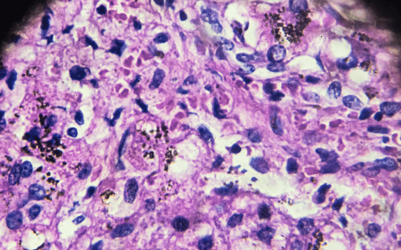 Biliary Cirrhosis