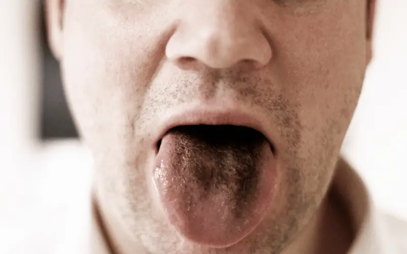 Black Hairy Tongue Syndrome