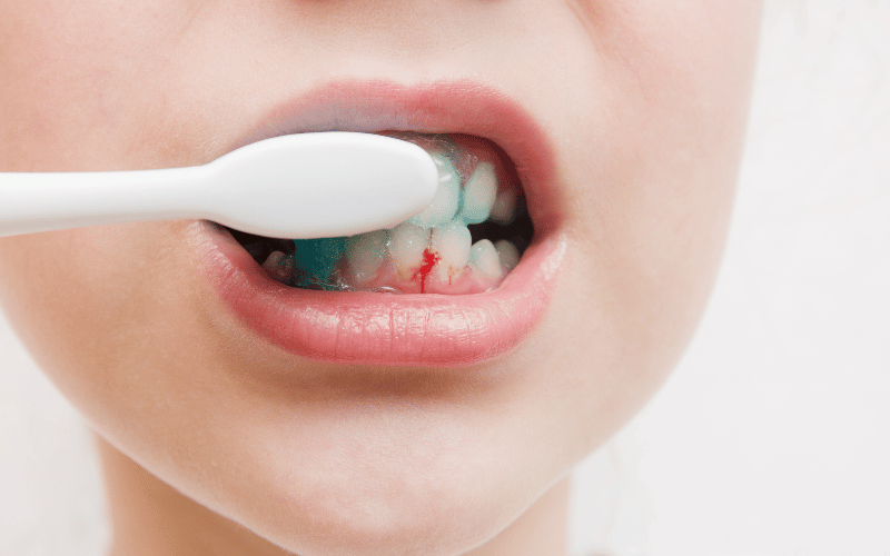 Bleeding During Brushing and Flossing – A Crimson Alert