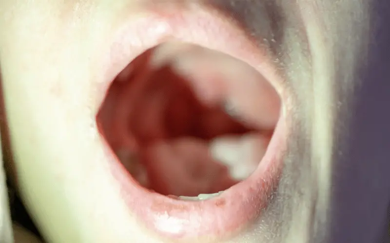 Bright Red Patches Inside the Mouth