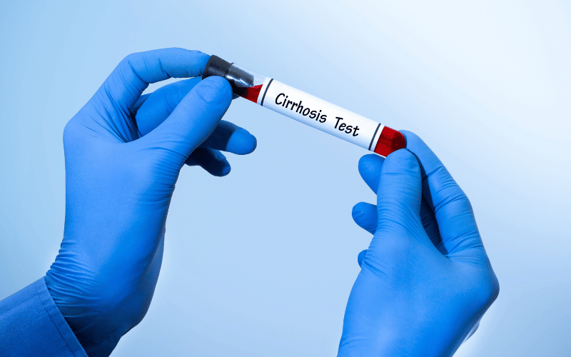 Cardiac Cirrhosis