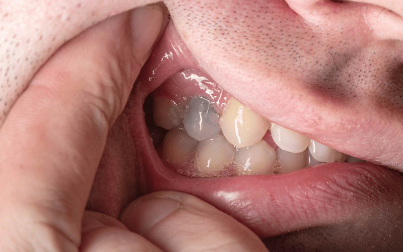 Changes in Tooth Color