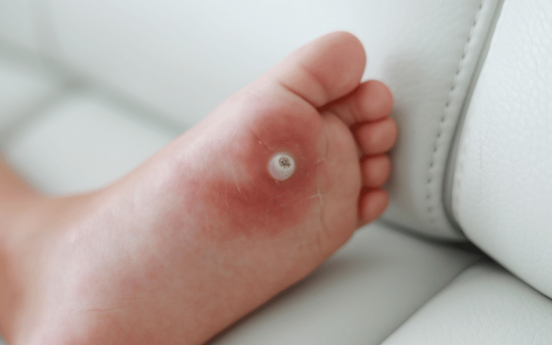 Connection with Other Warts