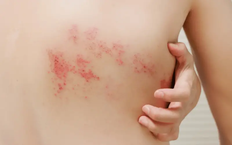 Deciphering the Early Signs of Shingles