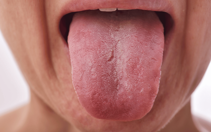 Deep Grooves on the Tongue's Surface