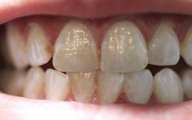 Discoloration of the Tooth A Common Red Flag