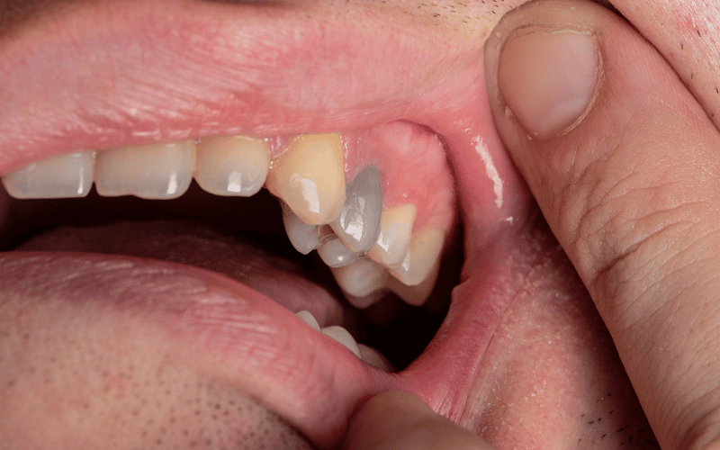 Discoloration of the Tooth