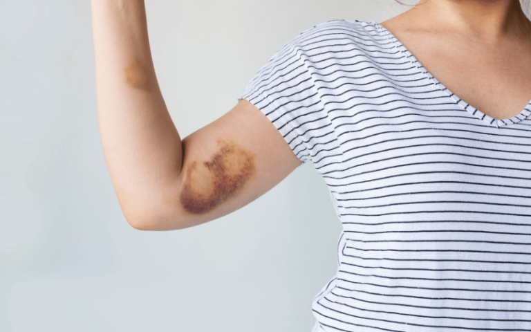 Unlocking the Enigma of Ehlers-Danlos Syndrome: A Deep Dive into its 