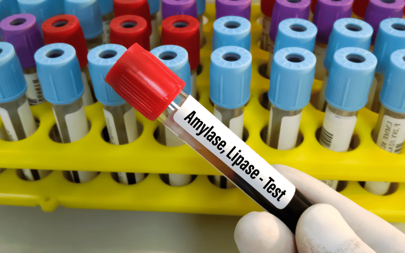 Elevated Amylase and Lipase Levels