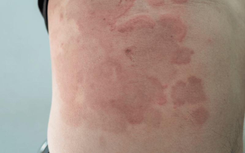 Erythema The Flaring Signal of Underlying Turmoil