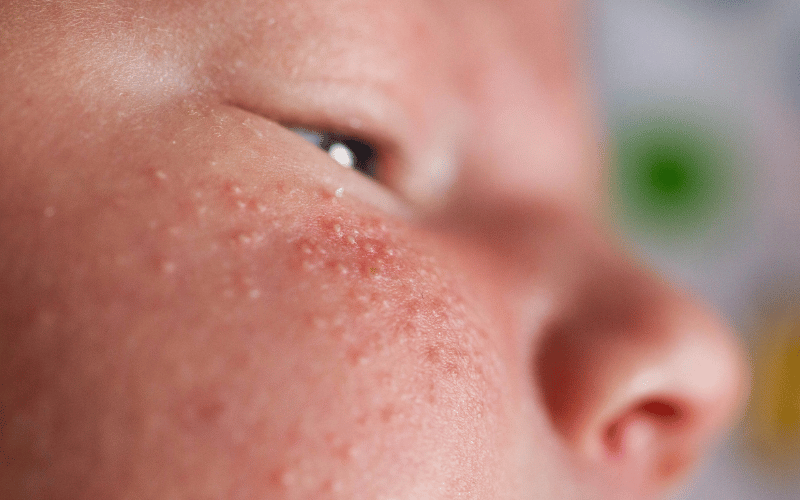 Facial Rashes - The Drool Effect