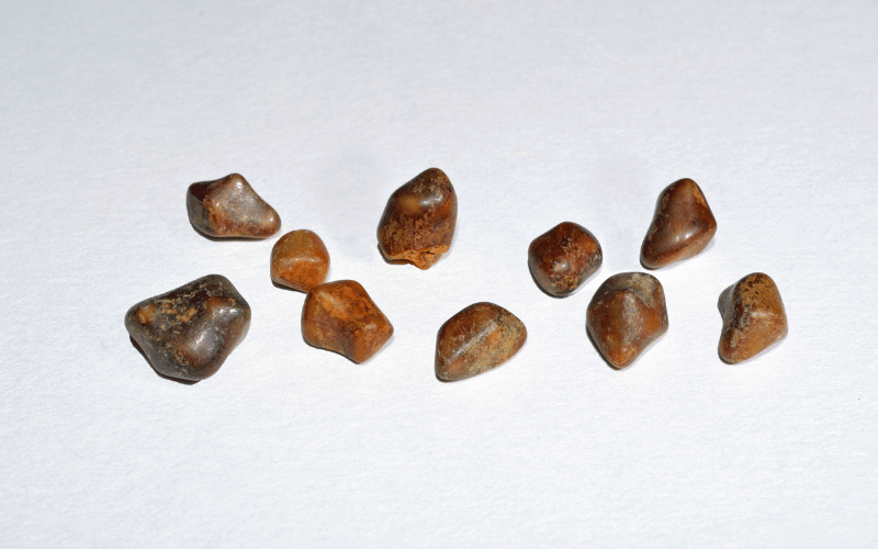 Gallstones in Relation to Other Health Conditions