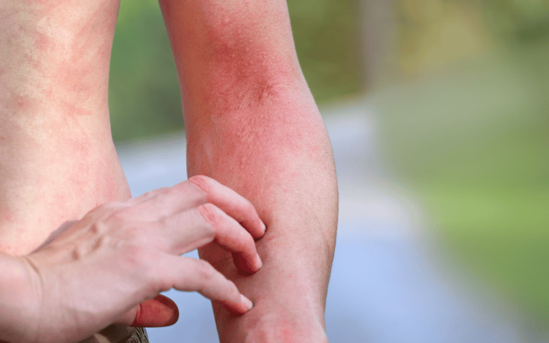 Heat-Induced Rashes