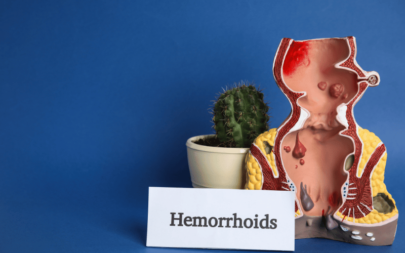 Hemorrhoids