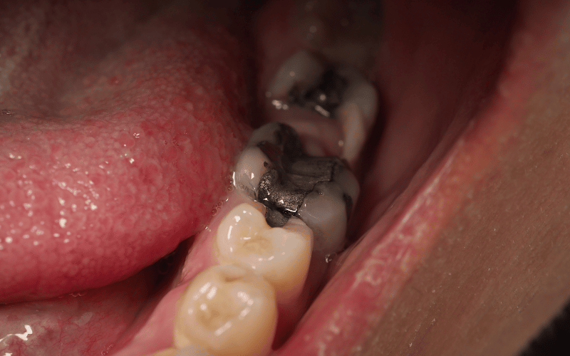 How Common is Tooth Decay