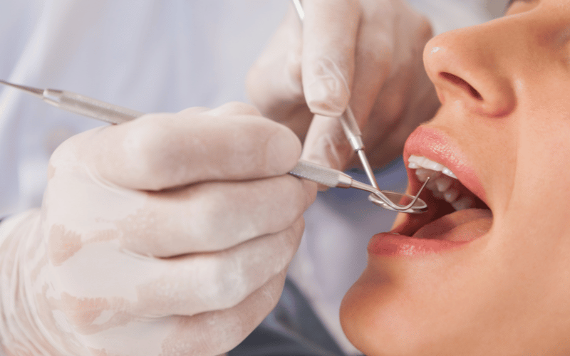 Identifying the Culprits Behind Pericoronitis