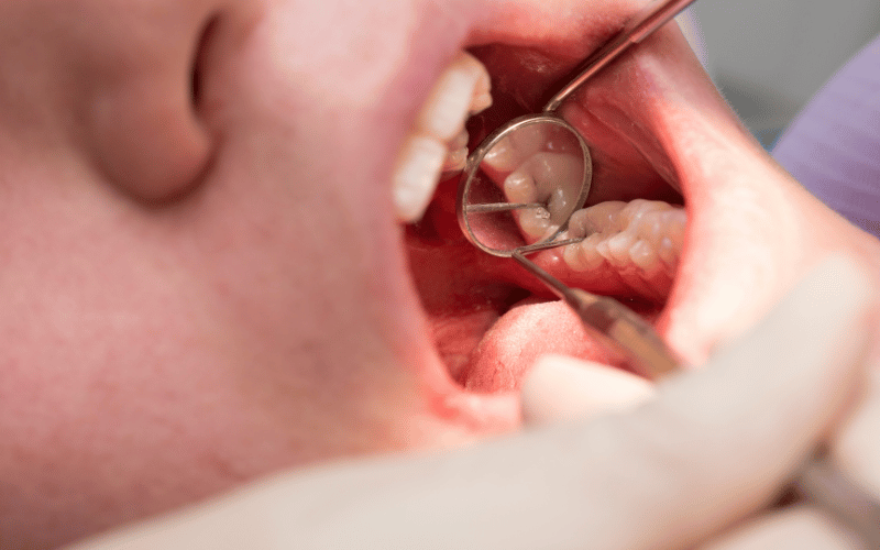 Increased Risk of Caries A Concern for DI Patients