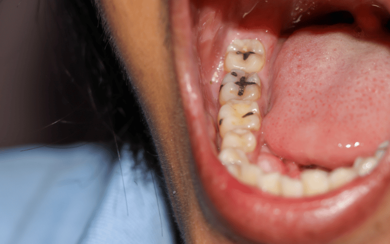 Increased Vulnerability to Cavities