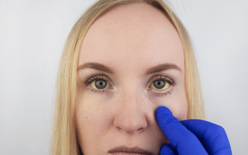 Jaundice – The Visual Red Flag