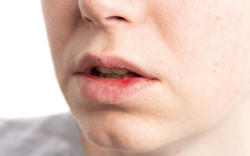 Lip Erosions or Ulcers