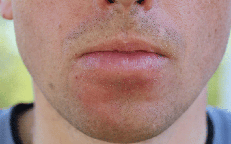 Lip Swelling