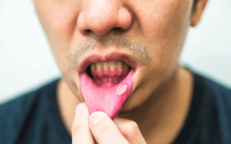 Mouth Ulcer Symptoms 10 Telltale Signs You Should Never Ignore