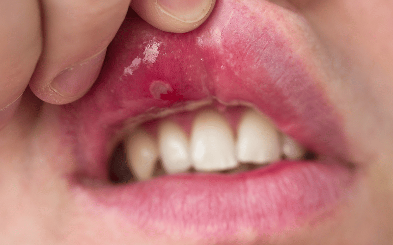 Navigating through the Mysteries of Stomatitis