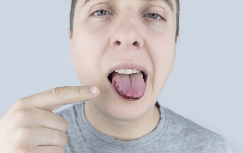 Occurrence After Minor Tongue Injuries