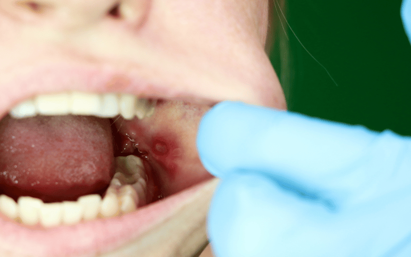 Painful Sores Inside the Mouth