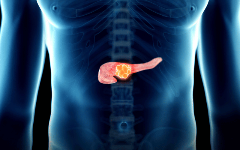 Pancreatic Calcifications