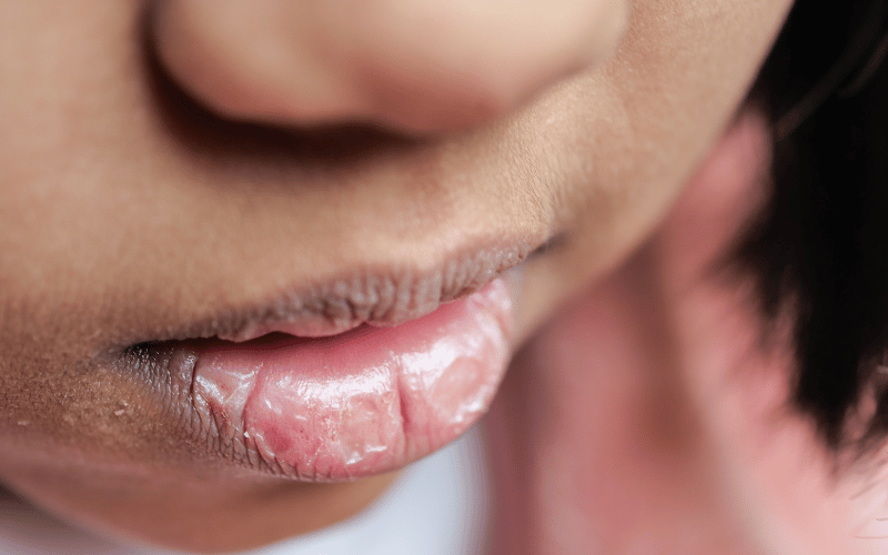 Persistent Lip Dryness