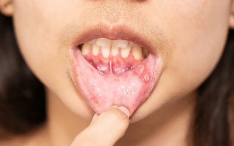 Persistent Mouth Sores