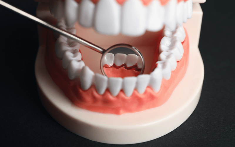 Pockets Between Gums and Teeth – A Hidden Hazard