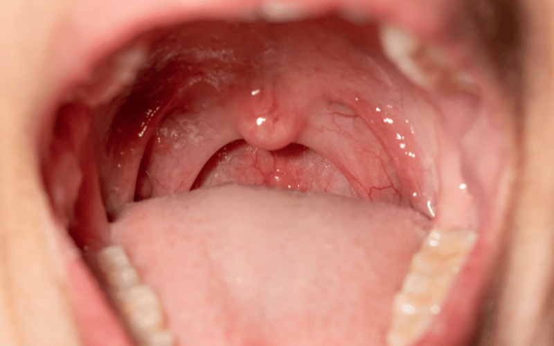 Presence of Warts in the Throat or Mouth