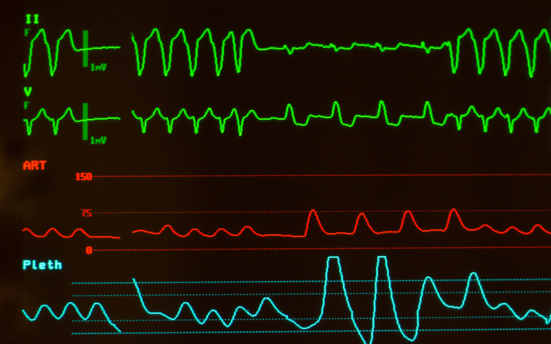 Rapid Breathing and Tachycardia Unraveling the Accelerated Rhythms