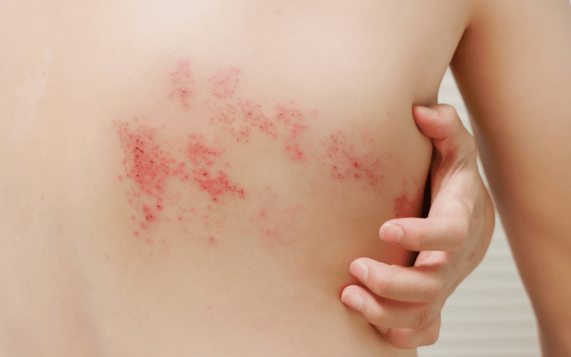 Red Skin Rash