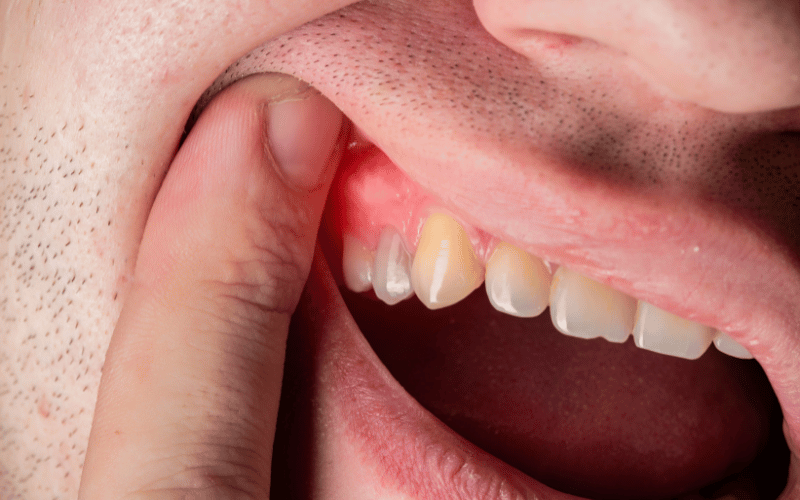 Red and Swollen Gums A Critical Indicator