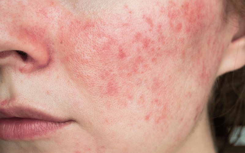 Rosacea and Skin Issues