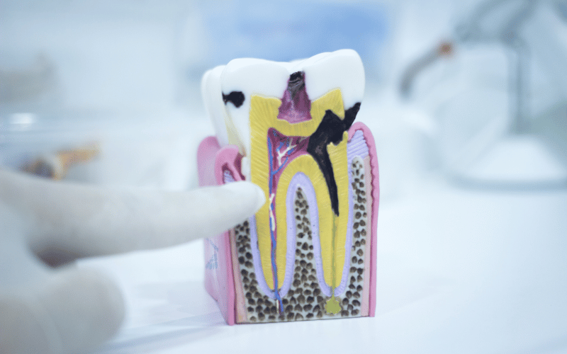 Shortened Tooth Roots