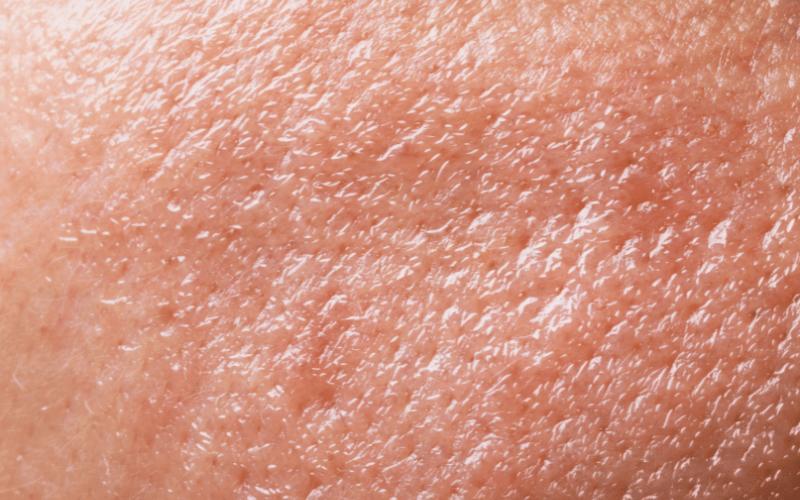 Skin Conditions