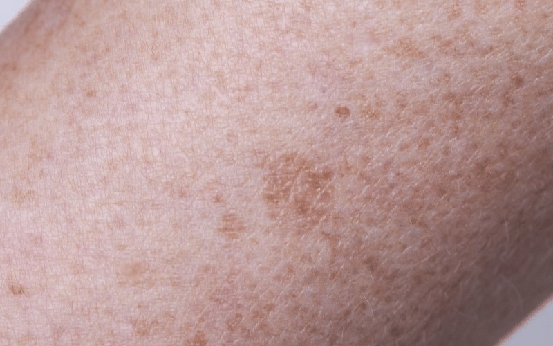 Skin Discoloration - A Visible Change You Can’t Ignore